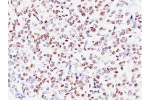 Formalin-fixed, paraffin-embedded human Melanoma stained with MITF Mouse Monoclonal Antibody (SPM290)