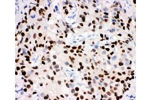 IHC-P: Progesterone Receptor antibody testing of human breast cancer tissue (Progesterone Receptor antibody  (AA 595-933))