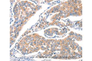 Immunohistochemistry of Human breast cancer using ART4 Polyclonal Antibody at dilution of 1:30