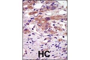 Formalin-fixed and paraffin-embedded human cancer tissue reacted with the primary antibody, which was peroxidase-conjugated to the secondary antibody, followed by AEC staining. (RPS6KA6 antibody  (N-Term))