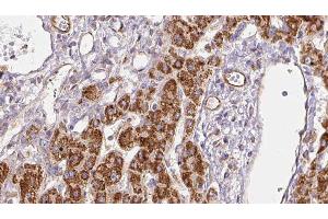 ABIN6278272 at 1/100 staining Human liver cancer tissue by IHC-P.
