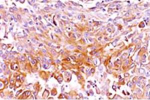 Immunohistochemical staining (Formalin-fixed paraffin-embedded sections) of human melanoma tissue with SILV monoclonal antibody, clone SPM286 . (Melanoma gp100 antibody)