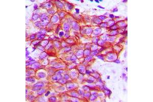 Immunohistochemical analysis of Claudin 5 staining in human breast cancer formalin fixed paraffin embedded tissue section. (Claudin 5 antibody  (C-Term))