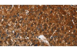 Immunohistochemistry of paraffin-embedded Human liver cancer tissue using CATSPER4 Polyclonal Antibody at dilution 1:50 (CATSPER4 antibody)