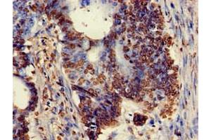 Immunohistochemistry of paraffin-embedded human colon cancer using ABIN7175897 at dilution of 1:100 (XRCC5 antibody  (AA 251-455))