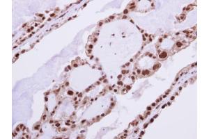IHC-P Image Immunohistochemical analysis of paraffin-embedded human ovarian cancer, using RAD23B, antibody at 1:250 dilution. (RAD23B antibody  (Center))