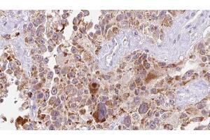 ABIN6273235 at 1/100 staining Human Melanoma tissue by IHC-P. (EGFL7 antibody  (Internal Region))