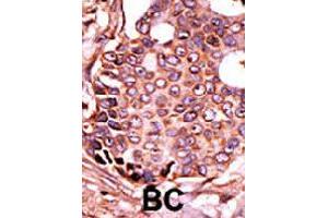 Formalin-fixed and paraffin-embedded human cancer tissue reacted with SEPHS2 polyclonal antibody  , which was peroxidase-conjugated to the secondary antibody, followed by DAB staining. (SEPHS2 antibody  (Internal Region))