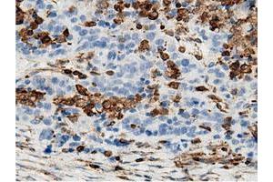 Immunohistochemical staining of paraffin-embedded Adenocarcinoma of Human colon tissue using anti-ARHGAP25 mouse monoclonal antibody. (ARHGAP25 antibody)