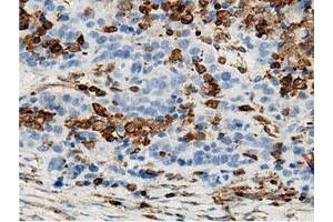 Immunohistochemical staining of paraffin-embedded Adenocarcinoma of Human colon tissue using anti-ARHGAP25 mouse monoclonal antibody. (ARHGAP25 antibody)