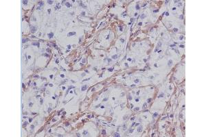 Immunohistochemical analysis of paraffin-embedded human liver cancer, using Fibronectin Antibody. (Recombinant Fibronectin antibody)