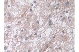 Detection of CPA4 in Human Glioma Tissue using Polyclonal Antibody to Carboxypeptidase A4 (CPA4)