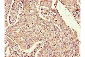Immunohistochemistry of paraffin-embedded human cervical cancer using ABIN7167815 at dilution of 1:100 (Retinoid X Receptor gamma antibody  (AA 13-133))