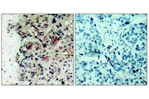 Immunohistochemical analysis of paraffin-embedded human breast carcinoma tissue using JAK1(Ab-1022) Antibody(left) or the same antibody preincubated with blocking peptide(right). (JAK1 antibody  (AA 1020-1024))