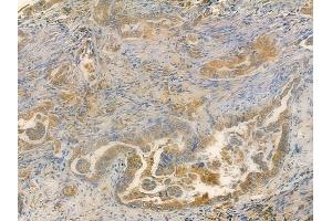 ABIN6257450 and ABIN6275471 at 1/100 staining human lung adenocarcinoma by IHC-P.