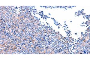 Immunohistochemistry of paraffin-embedded Human ovarian cancer using FAK Polyclonal Antibody at dilution of 1:75