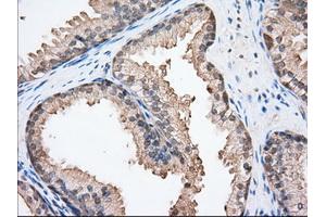 Immunohistochemical staining of paraffin-embedded Adenocarcinoma of Human ovary tissue using anti-BSG mouse monoclonal antibody. (CD147 antibody)