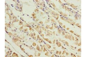 Immunohistochemistry of paraffin-embedded human gastric cancer using ABIN7157640 at dilution of 1:100 (KIF26B antibody  (AA 8-133))