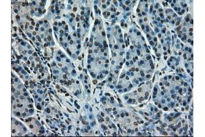 Immunohistochemical staining of paraffin-embedded Adenocarcinoma of colon tissue using anti-STK39mouse monoclonal antibody. (STK39 antibody)