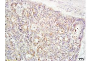 Formalin-fixed and paraffin embedded human rectal carcinoma labeled with Anti-RanBP1 Polyclonal Antibody, Unconjugated (ABIN1387616) at 1:200 followed by conjugation to the secondary antibody and DAB staining (RANBP1 antibody  (AA 86-116))