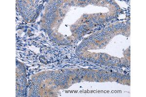 Immunohistochemistry of Human thyroid cancer using BDNF Polyclonal Antibody at dilution of 1:40 (BDNF antibody)
