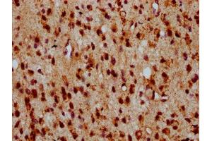 IHC image of ABIN7155865 diluted at 1:500 and staining in paraffin-embedded human glioma performed on a Leica BondTM system. (HIPK2 antibody  (AA 816-977))