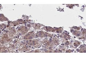 ABIN6273960 at 1/100 staining Human liver cancer tissue by IHC-P. (OR5AN1 antibody  (Internal Region))