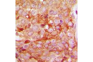 Immunohistochemical analysis of MMP11 staining in human breast cancer formalin fixed paraffin embedded tissue section.