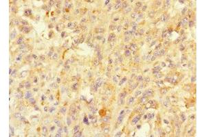 Immunohistochemistry of paraffin-embedded human melanoma using ABIN7160214 at dilution of 1:100 (MORN5 antibody  (AA 1-161))