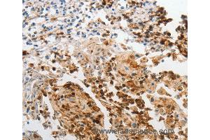 Immunohistochemistry of Human cervical cancer using LCN2 Polyclonal Antibody at dilution of 1:60 (Lipocalin 2 antibody)