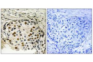 Immunohistochemistry analysis of paraffin-embedded human breast carcinoma tissue using OSR1 (Phospho-Thr185) antibody. (OSR1 antibody  (pThr185))