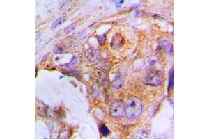 Immunohistochemical analysis of APAF-1 staining in human lung cancer formalin fixed paraffin embedded tissue section.
