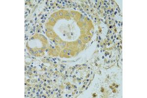 Immunohistochemistry of paraffin-embedded human lung cancer using PECR antibody (ABIN2564466) at dilution of 1:100 (40x lens). (PECR antibody)