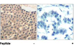 Immunohistochemical analysis of paraffin-embedded human lung carcinoma tissue using HDAC4/HDAC5/HDAC9 polyclonal antibody . (HDAC4 antibody  (Ser220, Ser246, Ser259))