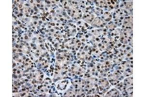 Immunohistochemical staining of paraffin-embedded Carcinoma of liver tissue using anti-CYP1A2 mouse monoclonal antibody.