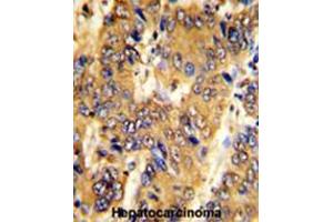 Formalin-fixed and paraffin-embedded human hepatocarcinoma with MSRB2 Antibody (Center), which was peroxidase-conjugated to the secondary antibody, followed by DAB staining. (MSRB2 antibody  (Middle Region))