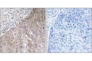 Immunohistochemistry analysis of paraffin-embedded human cervix carcinoma tissue, using APOL2 Antibody.