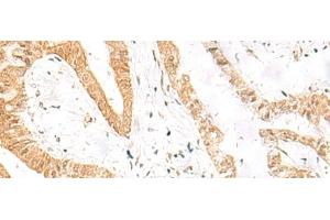 Immunohistochemistry of paraffin-embedded Human liver cancer tissue using HES7 Polyclonal Antibody at dilution of 1:25(x200)