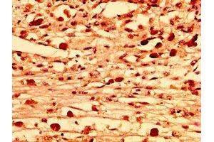 IHC image of ABIN7158070 diluted at 1:300 and staining in paraffin-embedded human melanoma performed on a Leica BondTM system. (LRRFIP2 antibody  (AA 211-342))