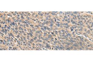 Immunohistochemistry of paraffin-embedded Human cervical cancer tissue using RPS14 Polyclonal Antibody at dilution of 1:50(x200) (RPS14 antibody)