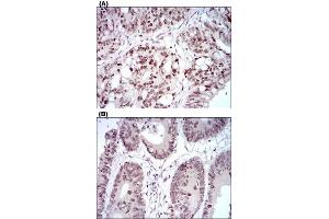 Immunohistochemical staining of human rectum cancer tissues (A) and colon cancer tissues (B) with HOXB4 monoclonal antibody, clone 3A2F2  at 1:200-1:1000 dilution.