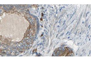 ABIN6275626 at 1/100 staining Human prostate tissue by IHC-P. (CCT6A antibody  (Internal Region))