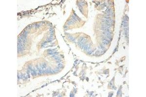 Immunohistochemistry of paraffin-embedded human endometrial cancer using ABIN7144333 at dilution of 1:100 (SLPI antibody  (AA 26-132))