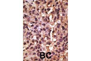 Formalin-fixed and paraffin-embedded human breast cancer tissue reacted with BNIP3 polyclonal antibody  , which was peroxidase-conjugated to the secondary antibody, followed by DAB staining.