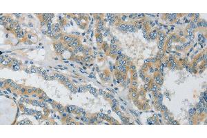 Immunohistochemistry of paraffin-embedded Human thyroid cancer tissue using Connexin-45 Polyclonal Antibody at dilution 1:50 (GJC1 antibody)