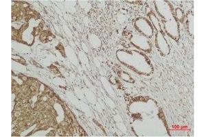 Immunohistochemical analysis of paraffin-embedded human Breast caricnoma using ERK 3 Polyclonal Antibody. (MAPK6 antibody)