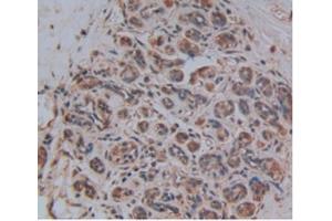 Detection of CRN in Human Breast Cancer Tissue using Polyclonal Antibody to Corin (CRN) (Corin antibody  (AA 134-573))