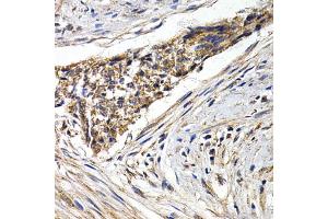 Immunohistochemistry of paraffin-embedded human esophagus cancer using FZR1 antibody (ABIN5973232) at dilution of 1/200 (40x lens). (FZR1 antibody)