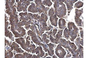 IHC-P Image LYRIC antibody [N2C3] detects LYRIC protein at cytosol on human endometrial carcinoma by immunohistochemical analysis. (MTDH antibody)