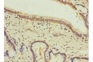 Immunohistochemistry of paraffin-embedded human prostate cancer using ABIN7153669 at dilution of 1:100